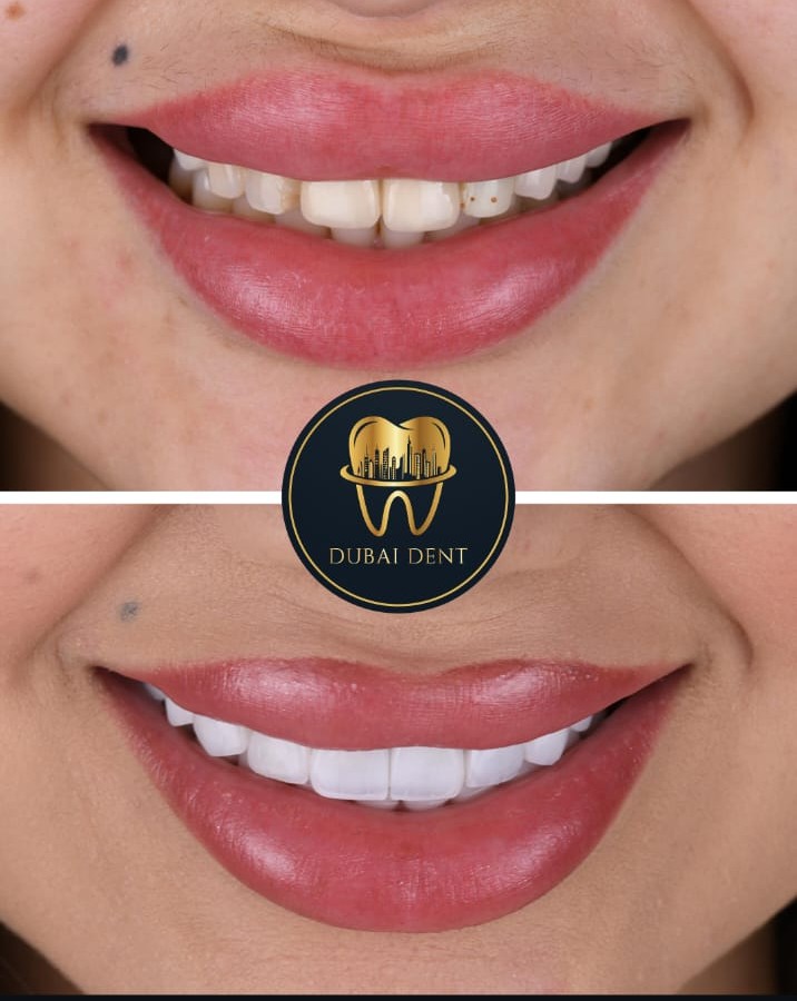 Dubai Dent cosmetic dentistry result